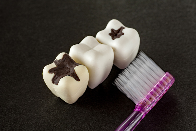 むし歯とはどのような病気か