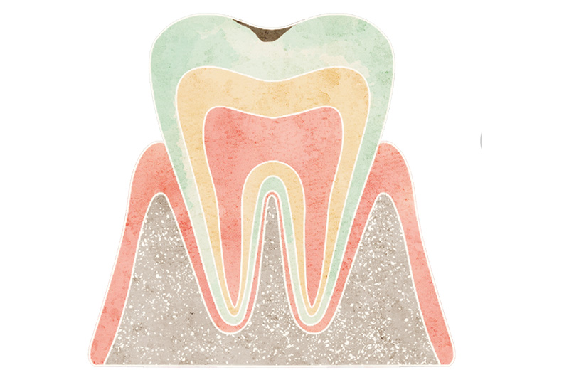 エナメル質にとどまるむし歯（C1）