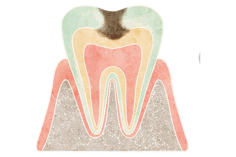 象牙質まで進行したむし歯（C2）