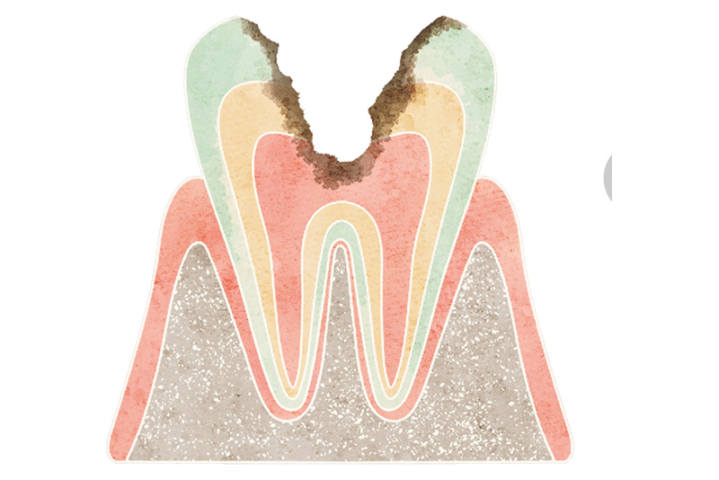 神経まで達したむし歯（C3）