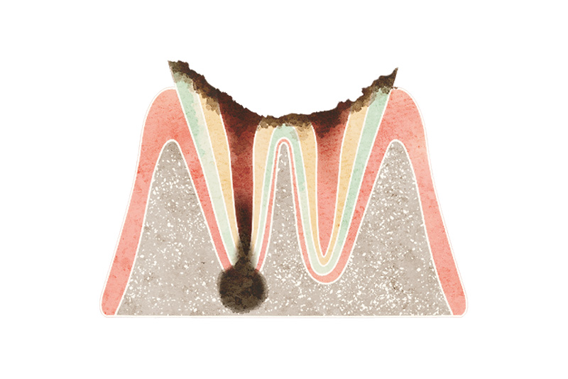 歯根だけが残った状態（C4）