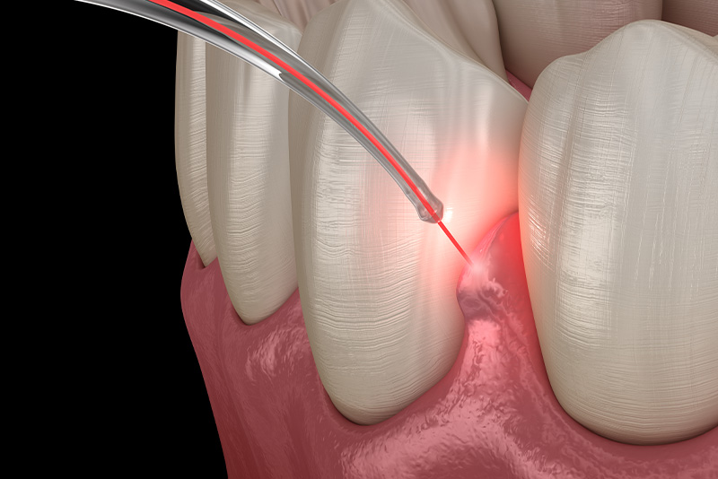 麻酔やレーザー治療で痛みに配慮
