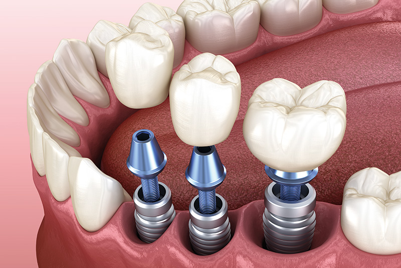 インプラントとは？（自由診療）