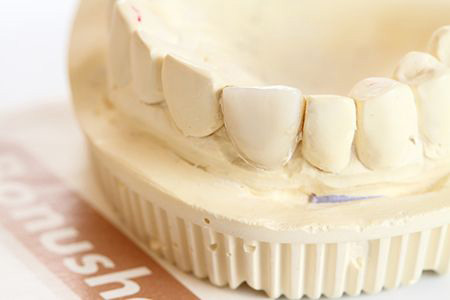 人工歯の型取り・仮歯の装着