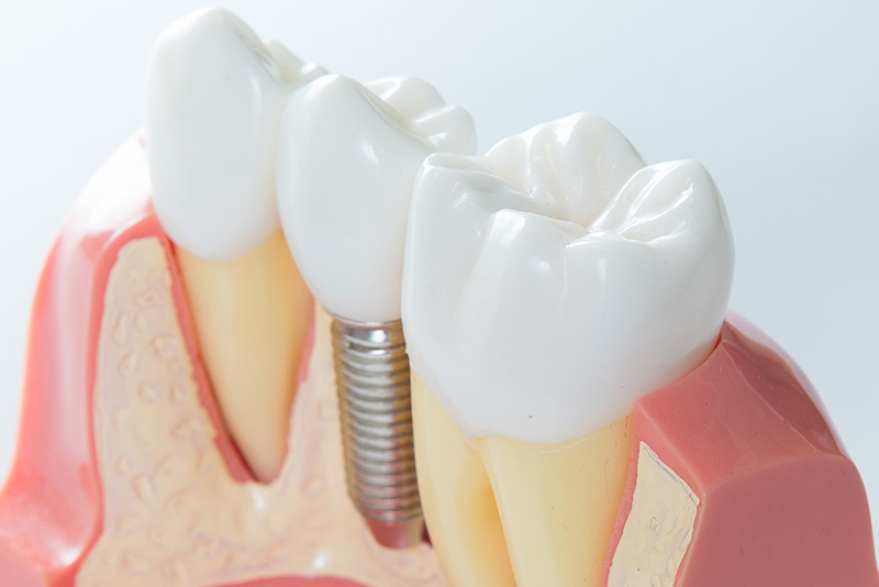 インプラント周囲炎
