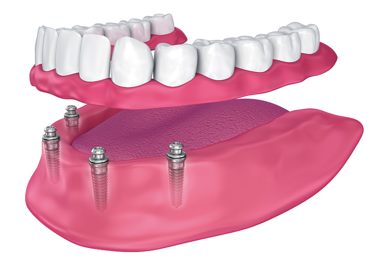 「インプラントオーバーデンチャー」にも対応