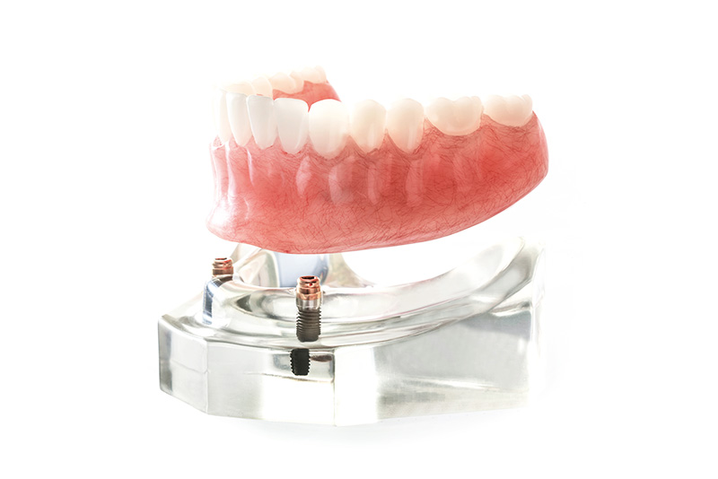 インプラントオーバーデンチャーが向いている方