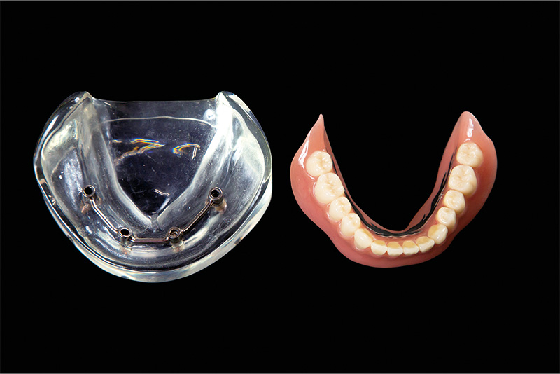 インプラントオーバーデンチャーのメリット