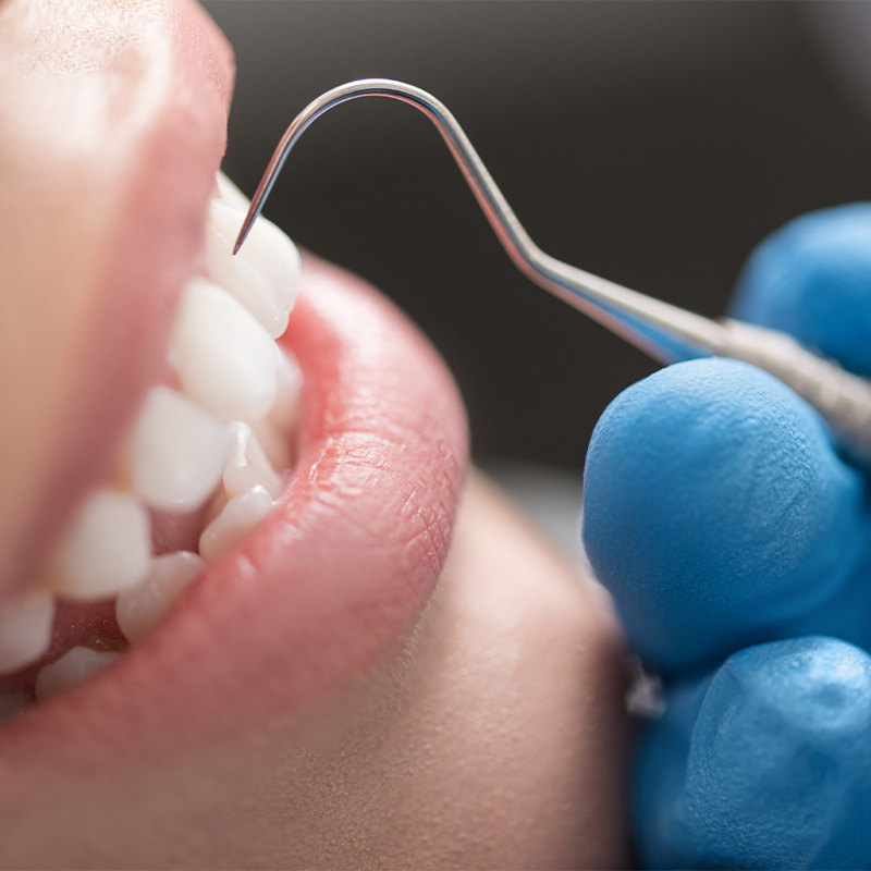 予防・クリーニング